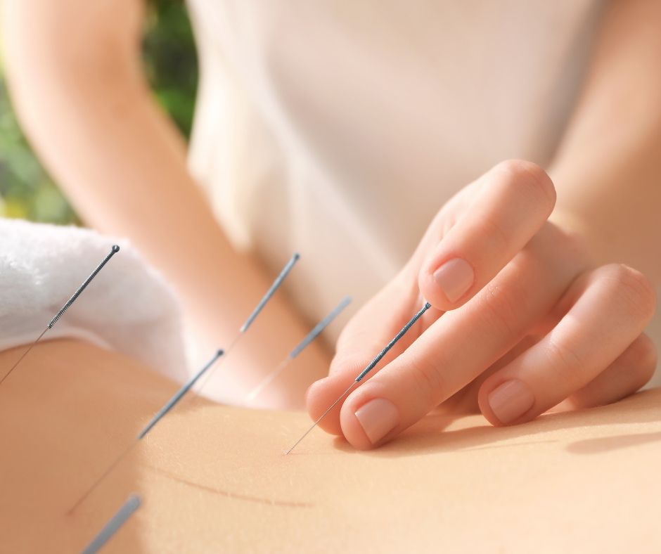 An acupuncturist gently inserts acupuncture needles into a patient's lower back.